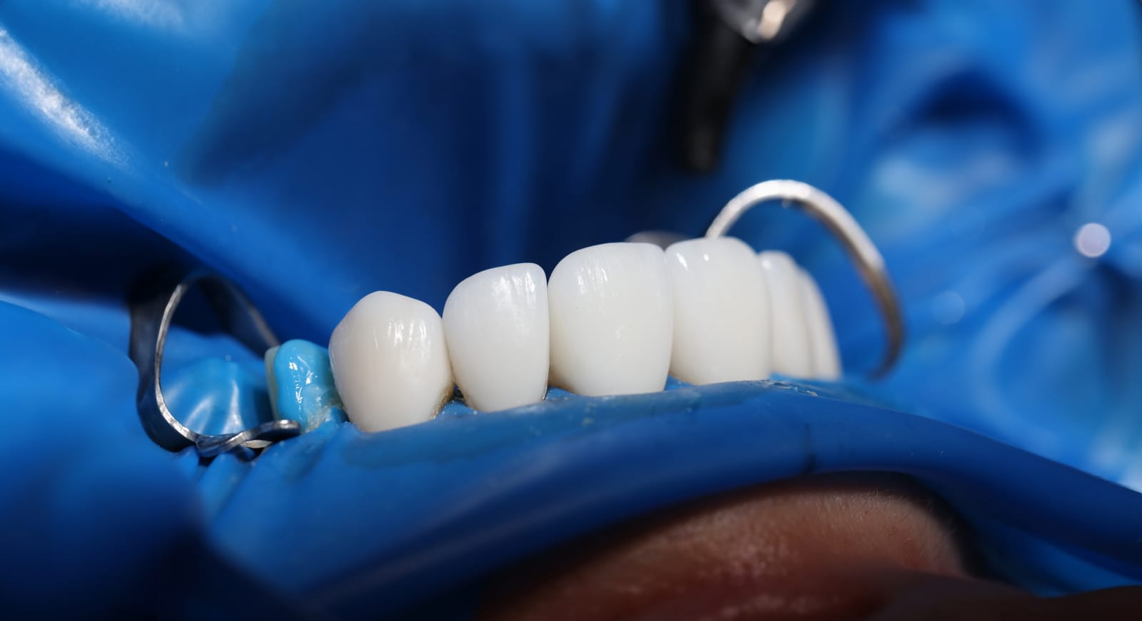 Composite Bonding in Glasgow: All You Need to Know Before Getting It Sloan Dental